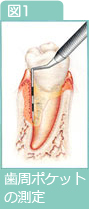 図1：歯周ポケットの測定