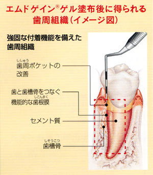 進行する歯周病のイメージ図